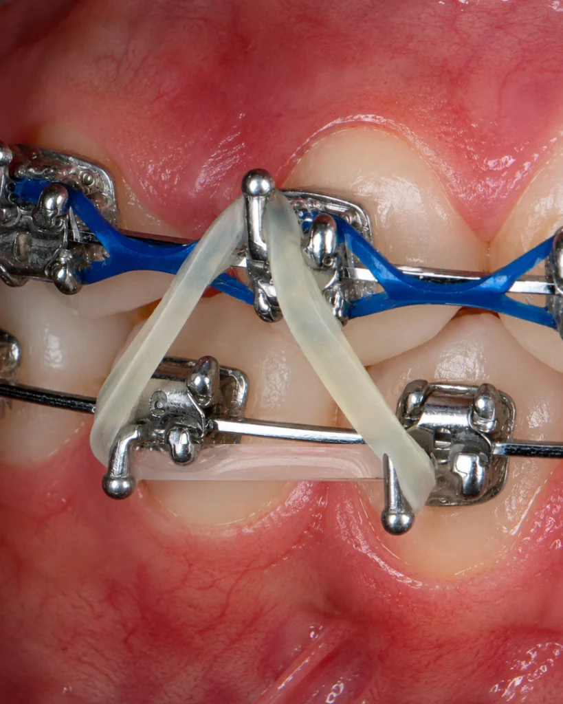 Orthodontic structural alignment using premium tooth braces at Oval Dental Clinic