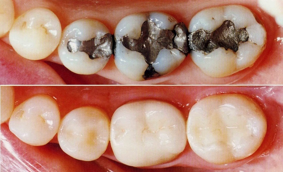 Composite teeth filling replacing silver amalgam filling